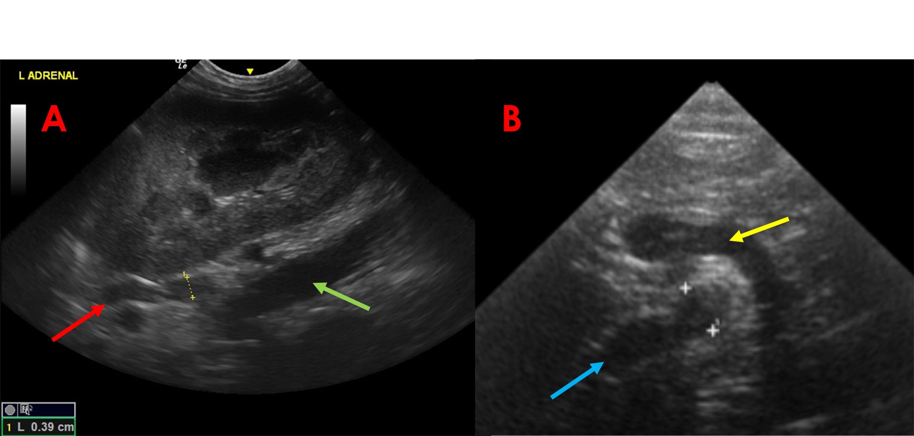 IMAGE 4 Left Adrenal Images