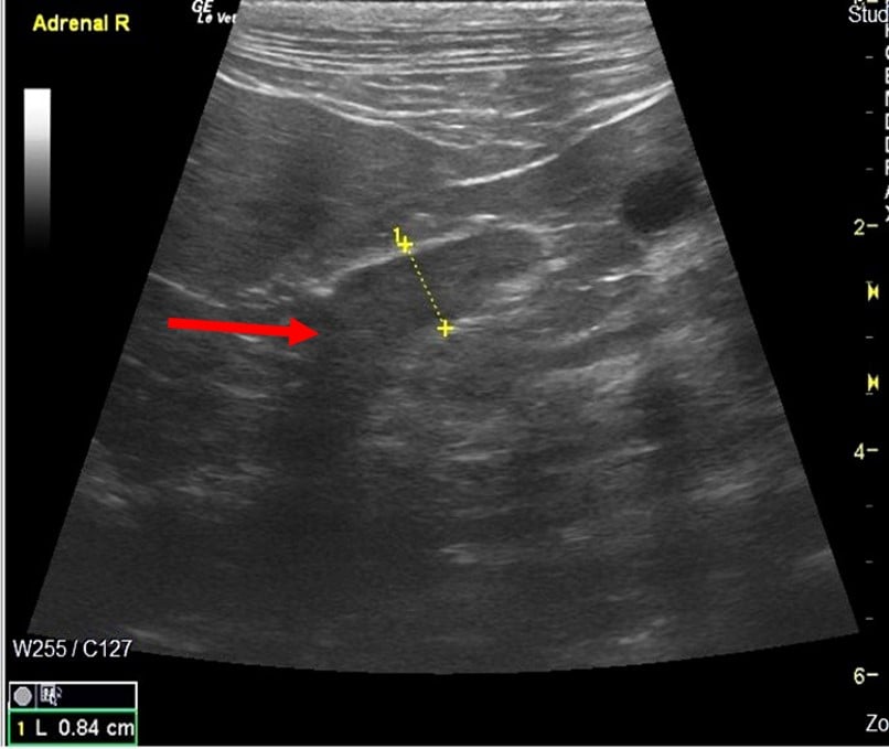 IMAGE 6 Right Adrenal