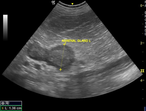 IMAGE 7 Enlarged Adrenal