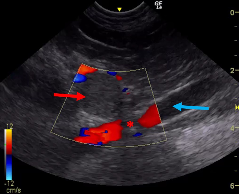 IMAGE 8 Adrenal Neoplasia