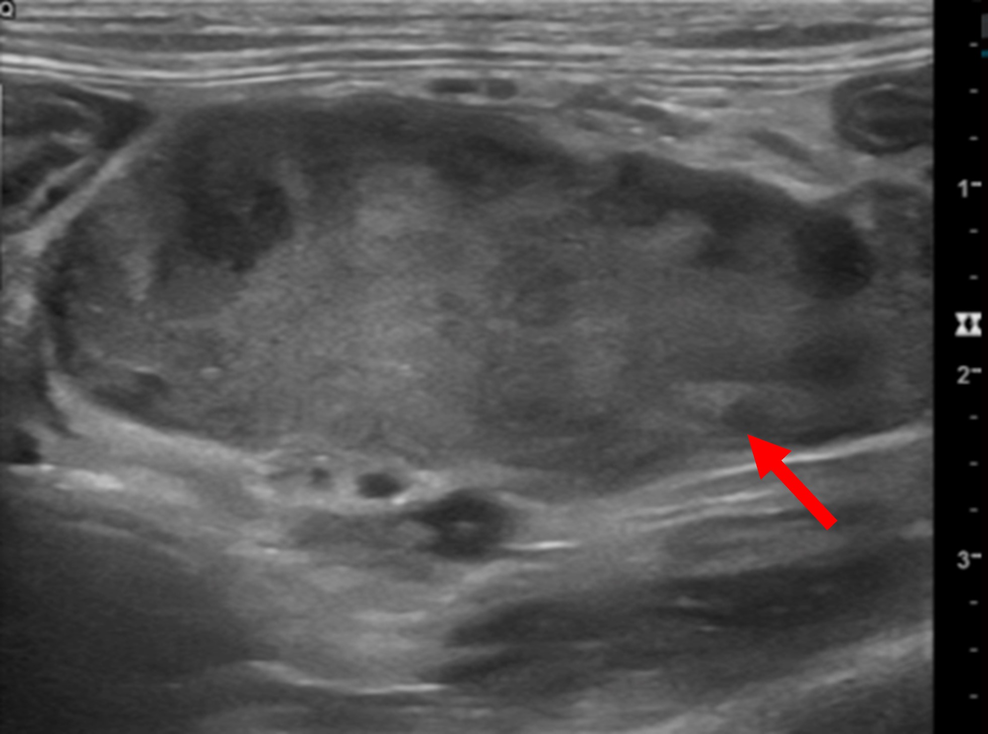Ultrasonography of the Lymph Nodes