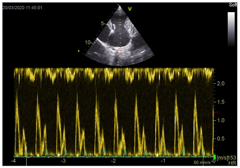 Pulsed wave doppler image courtesy of Emily Dutton at Cheshire Cardiology -1